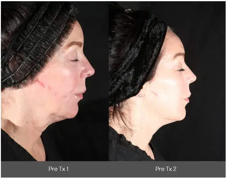 XERF treatment before and after result