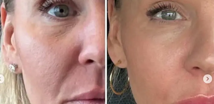 XERF skin tightening before and after result