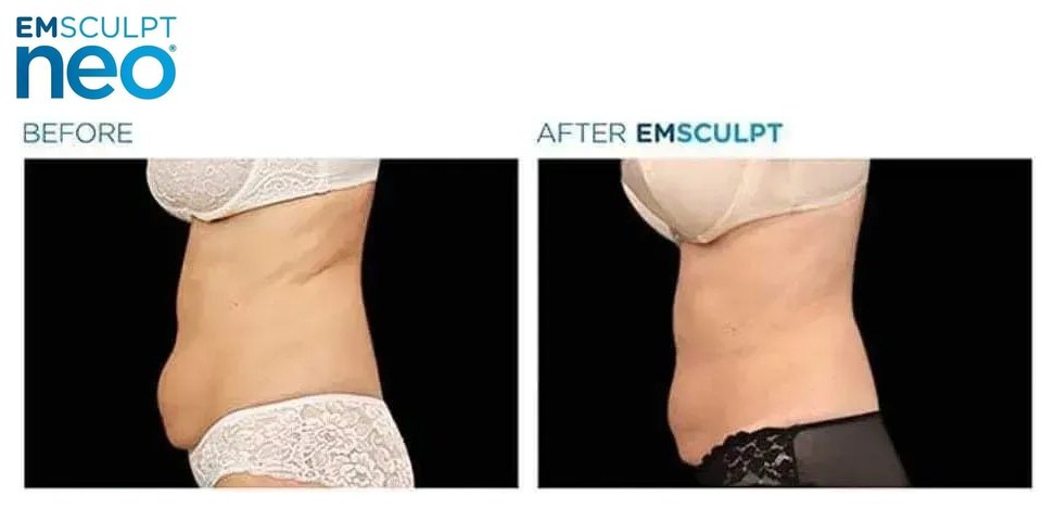 EMSCULPT NEO before and after, abdomen profile view