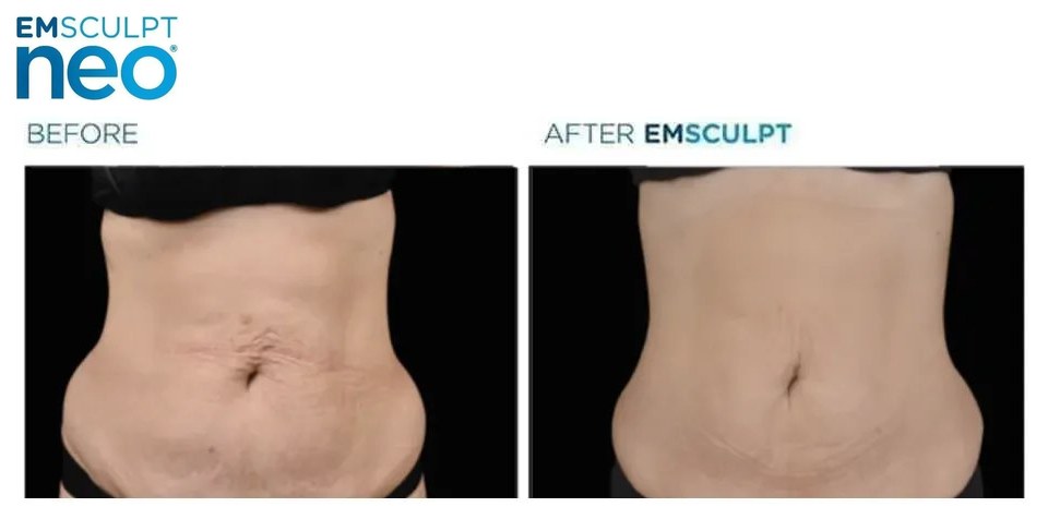 EMSCULPT NEO before and after, abdomen front view