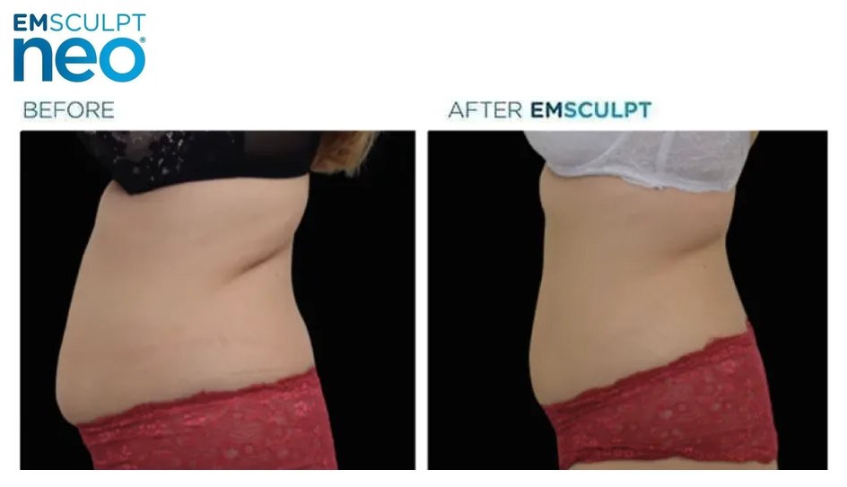 EMSCULPT NEO before and after, waist and flank profile view