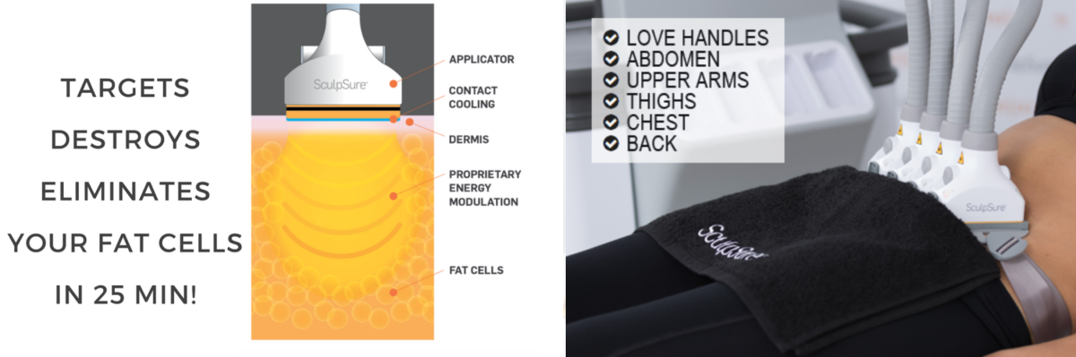 SculpSure Laser - The 25 Min Game Changer
